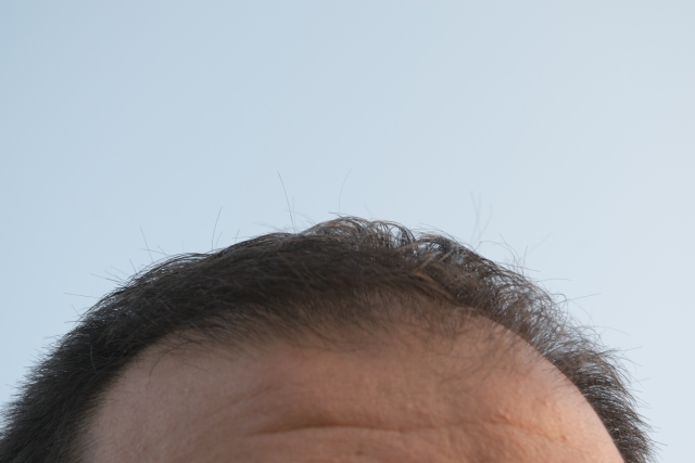 おでこに産毛が増えたら薄毛のサイン！生え際の薄毛対策は？