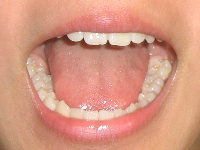 舌に歯型がある人はむくみや食いしばりが原因？改善方法は？
